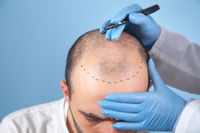 Hair Restoration Dubai treatment showcasing natural-looking hair replacement results at Hair Center Dubai