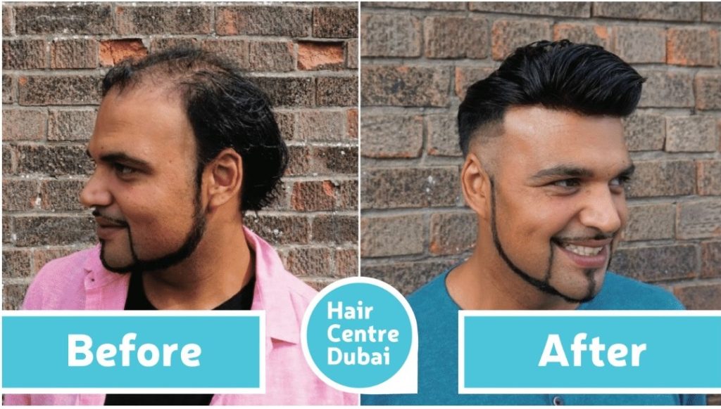 Hair replacement consultation at a clinic showing a specialist discussing simple hair replacement solutions with a patient