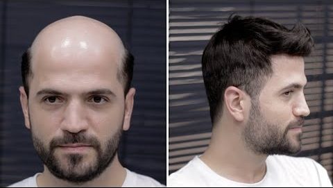 Professional hair replacement center in Dubai providing natural hair solutions