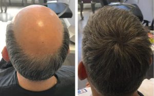 Hair fixing benefits before and after full scalp coverage transformation for improved hair volume