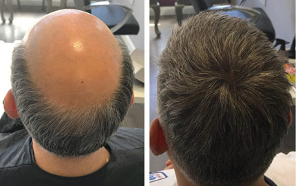 Hair fixing benefits before and after full scalp coverage transformation for improved hair volume