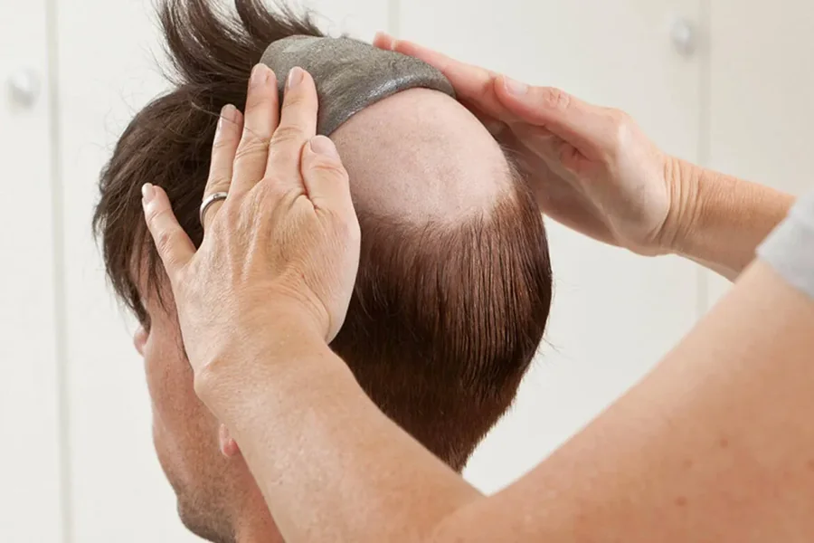 Hair Replacement Dubai before and after results showing natural hair coverage and restored appearance