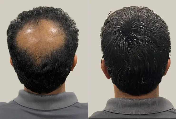 Hair Replacement Dubai before and after transformation showing natural-looking hair restoration results