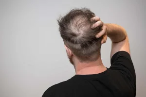 Man checking early signs of balding with visible hair thinning and receding hairline in the mirror