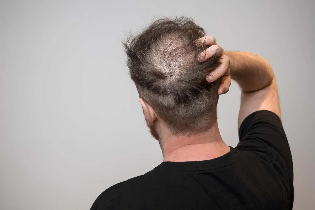 Man checking early signs of balding with visible hair thinning and receding hairline in the mirror