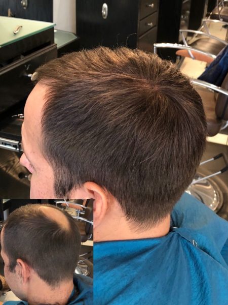 Hair Center Dubai professional hair transplant consultation and treatment process