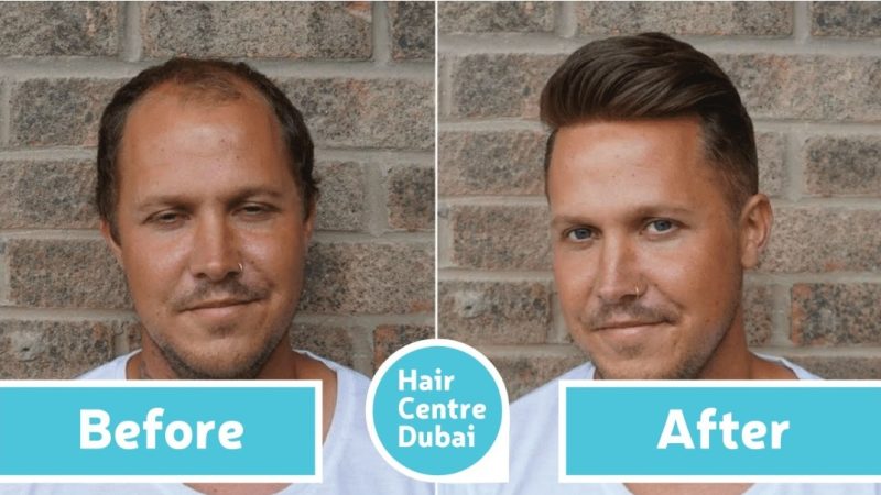 Hair Center Dubai consultation showing patient discussing hair transplant treatment with a specialist in a clinic environment