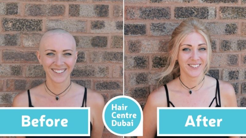 Hair Center Dubai consultation scene with a specialist discussing hair transplant treatment options with a patient in a clinic setting