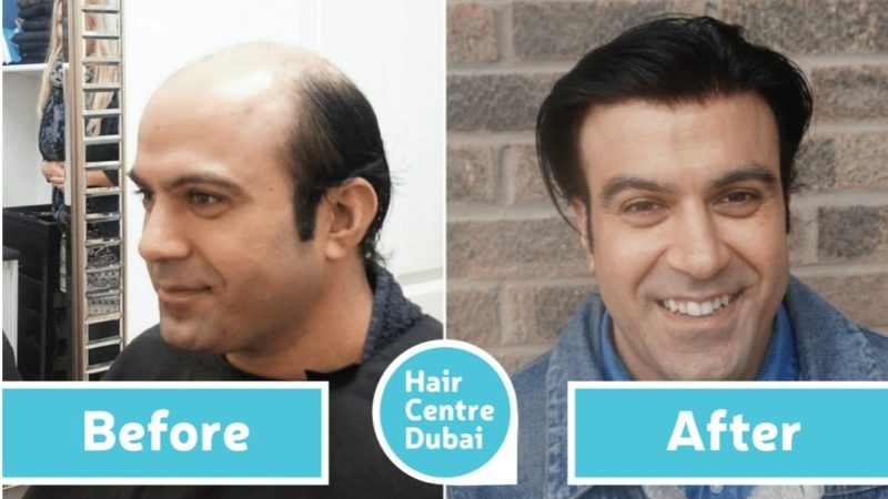 Hair Center Dubai specialist consulting with a patient during a hair transplant evaluation in a professional clinic environment