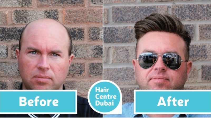 A professional consultation at Hair Center Dubai where a specialist carefully examines the patient’s hair and explains suitable hair restoration treatment options.